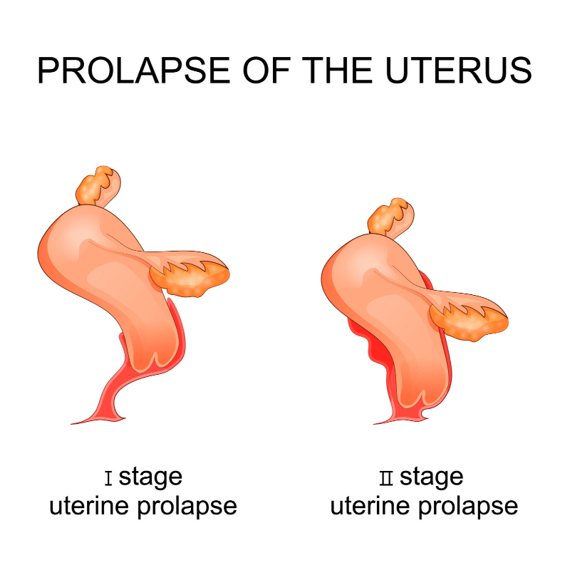 Uterine Prolpase